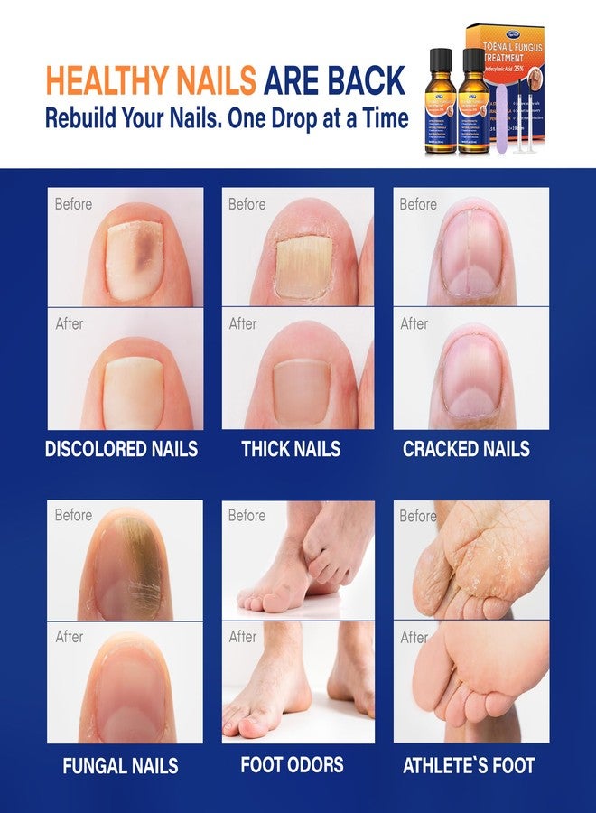 VigorWell Toenail Fungus Treatment with 25% Undecylenic Acid: Toenail Fungus Treatment Extra Strength for Thick, Yellow and Damaged Nails - Safe and Gentle for Nails Care - Image 2